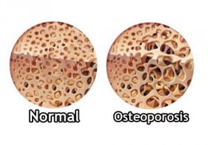 Osteoporosis_-500x350